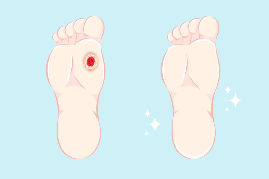 how to manage diabetic foot ulcers