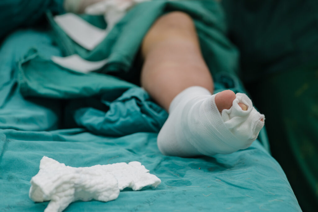 Wound Care for Diabetic Foot Ulcers