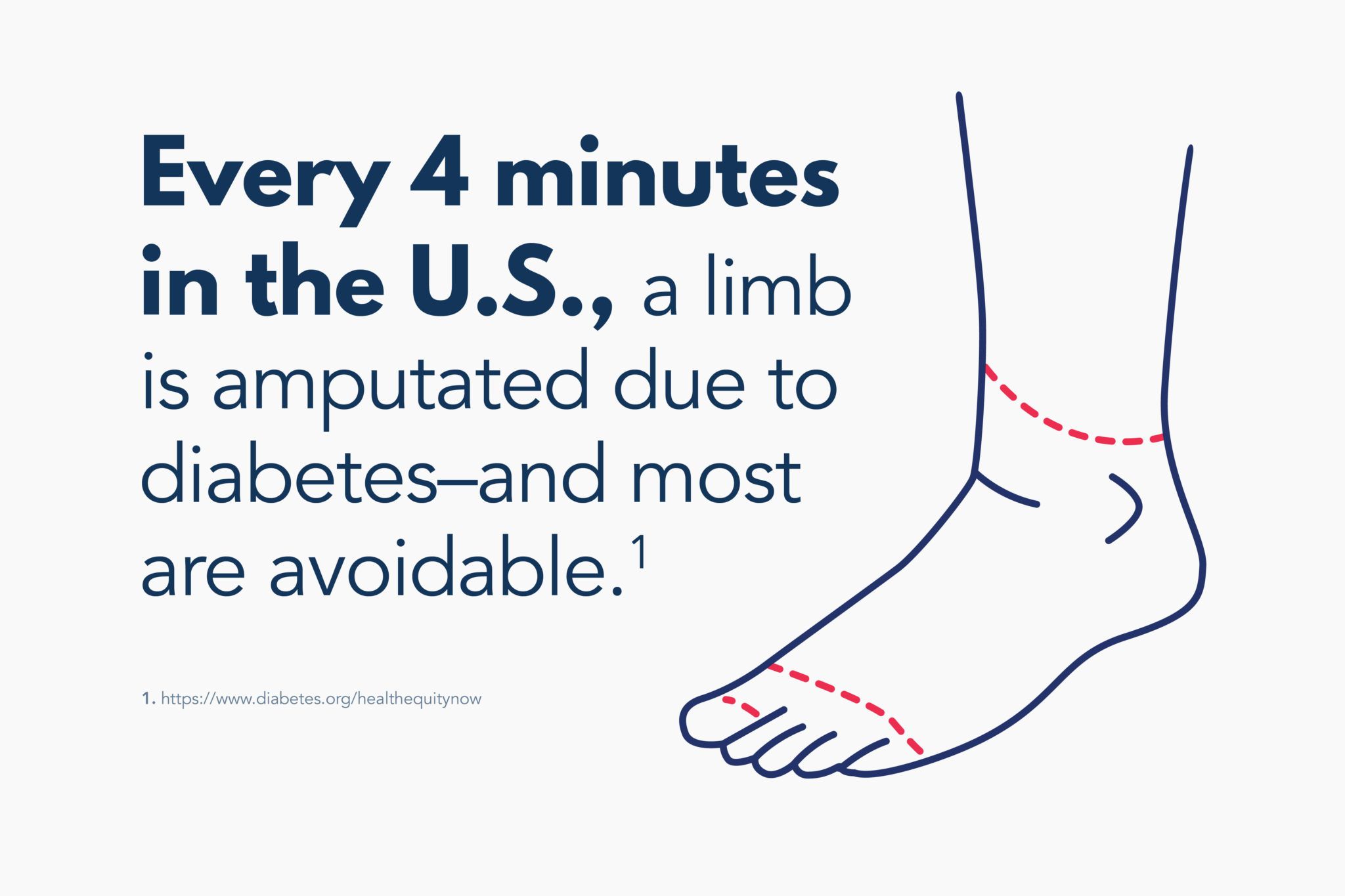 Diabetes amputations the complication hiding in plain sight